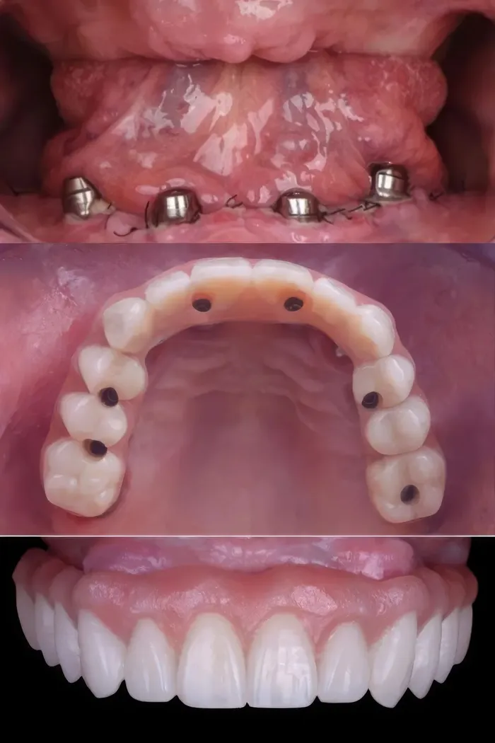 Tri kroky ošetrenia: implantáty s multi-unit nadstavbami v čeľusti, spodná strana hotového mostíka so skrutkovacími kanálikmi a hotový zubný oblúk spredu.