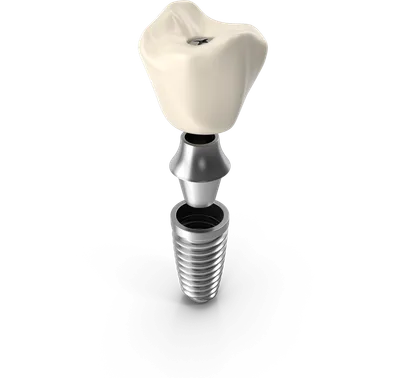 Keramická korunka na nadstavbe a implantáte